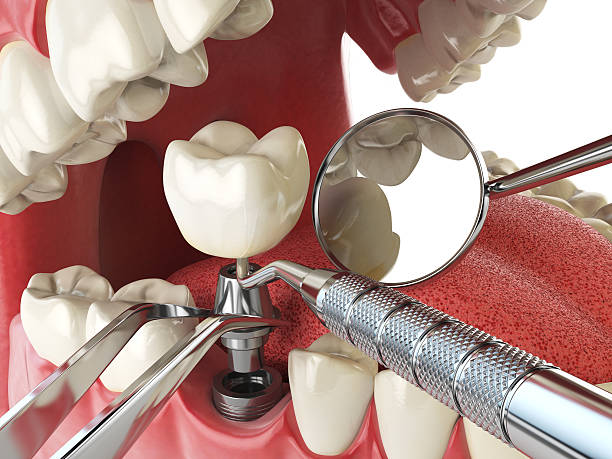 Best Knocked-Out Tooth (Avulsed Tooth) Treatment in Morris, AL